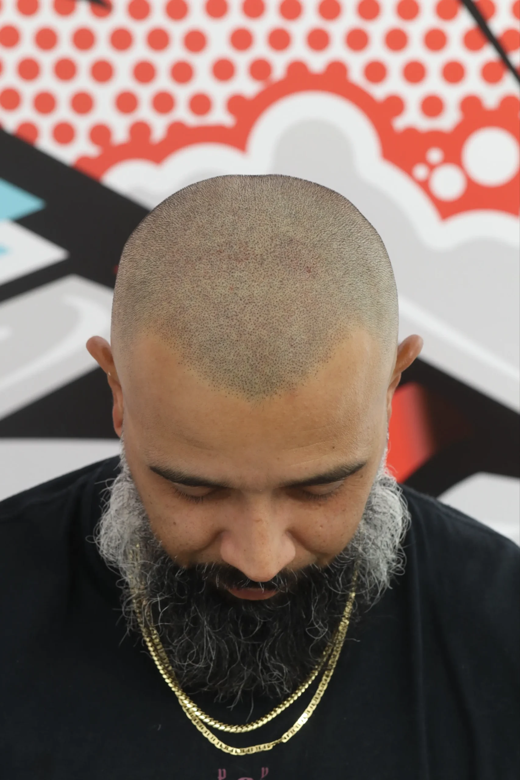 Density Fill after scalp micropigmentation