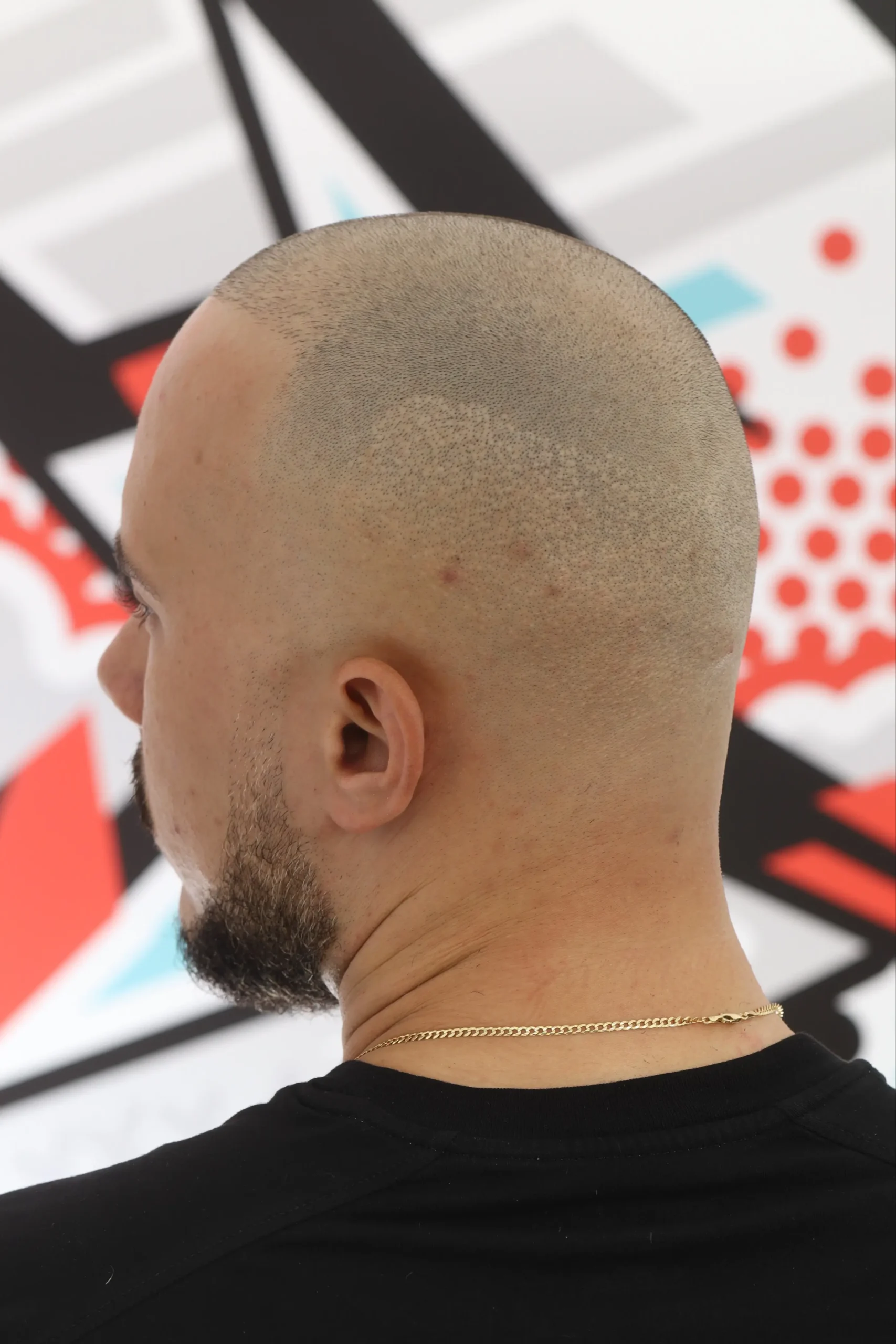 Scar Camouflage before scalp micropigmentation