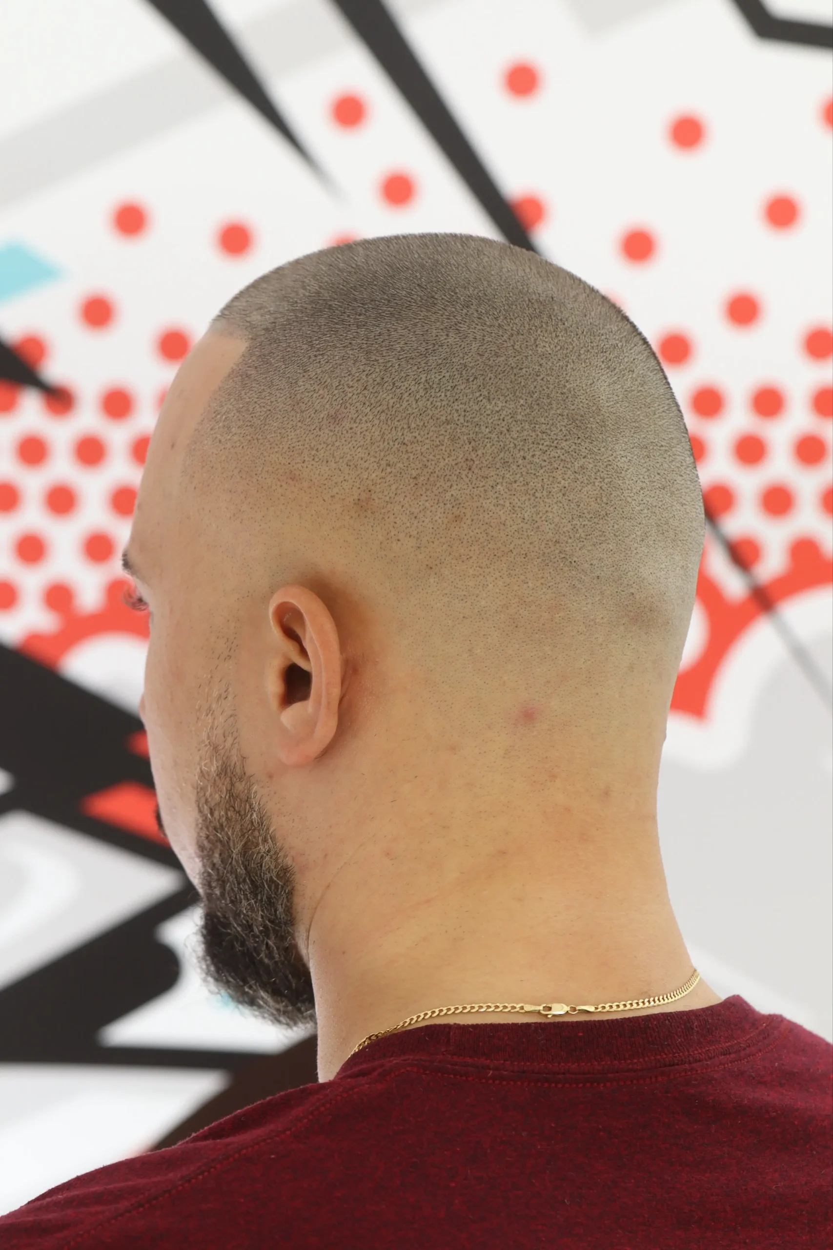 Scar Camouflage after scalp micropigmentation