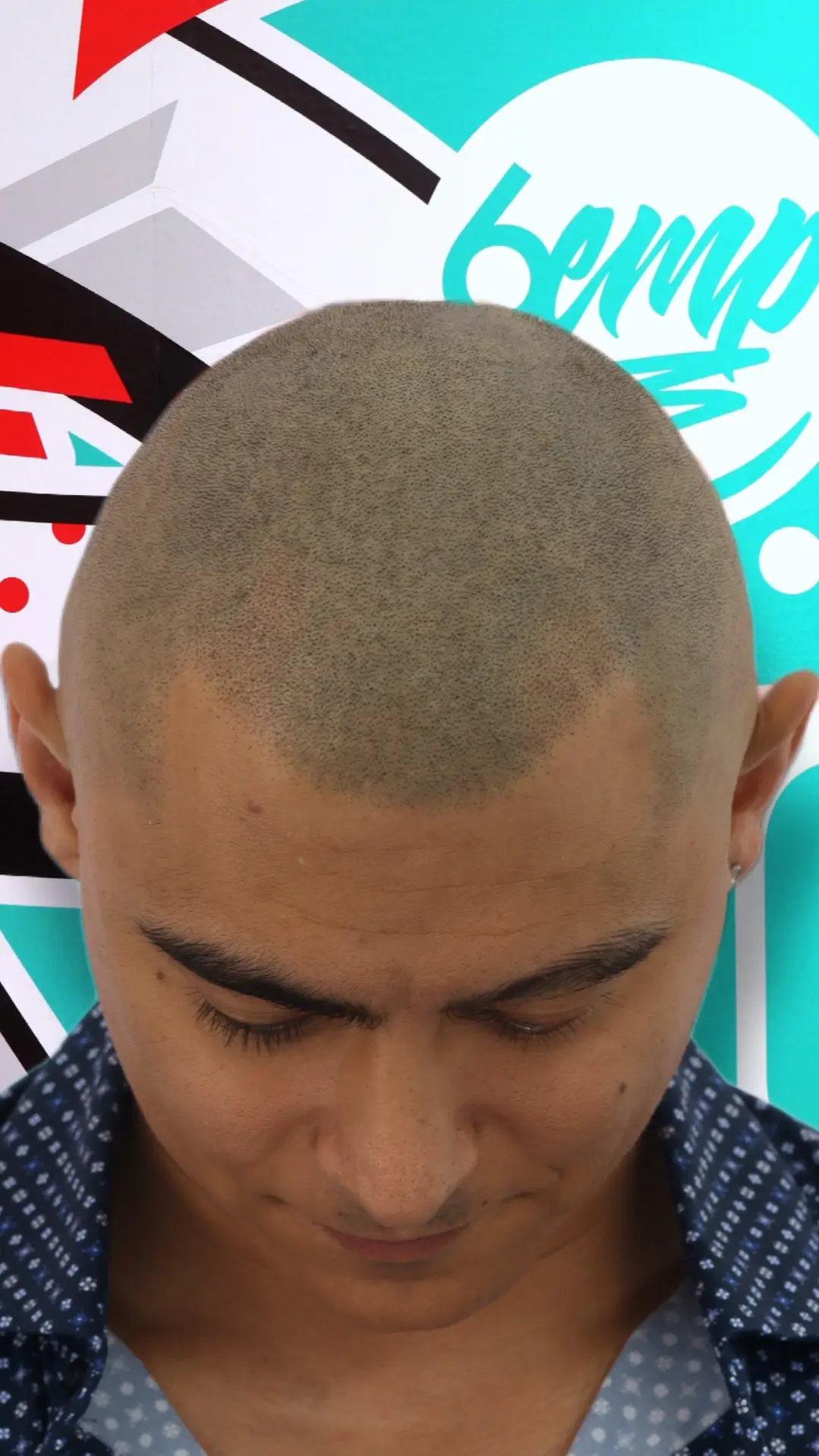 Alopecia after scalp micropigmentation