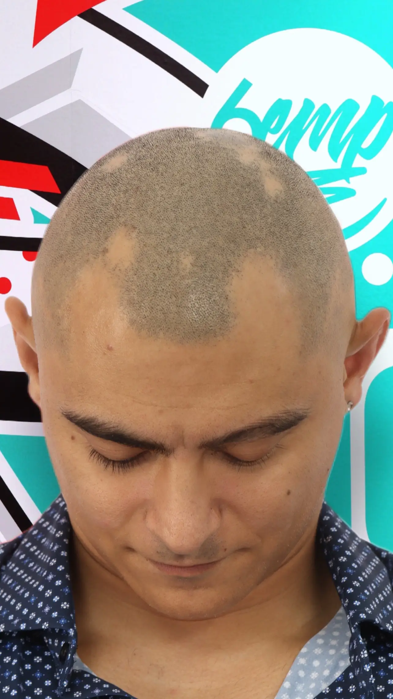 Alopecia before scalp micropigmentation