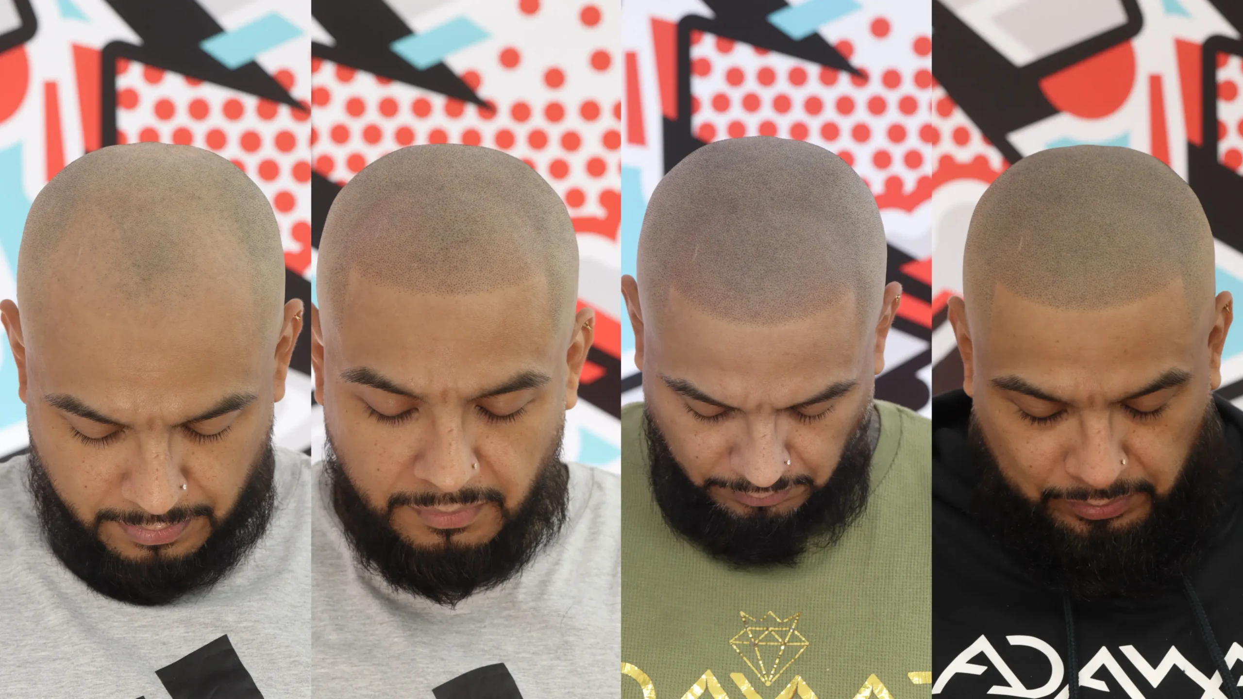 Scalp micropigmentation process showing before, first session, second session, and third session
