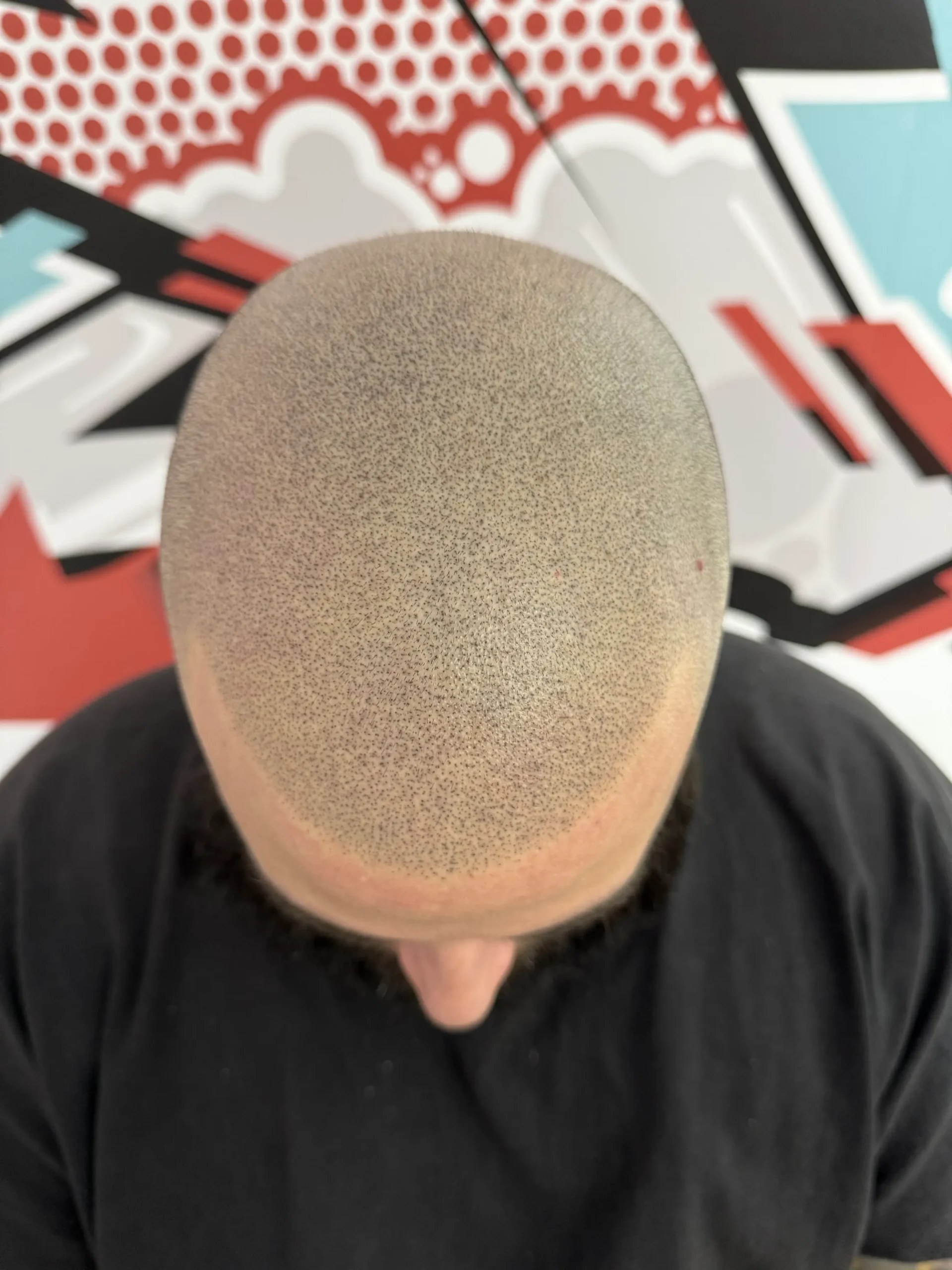 Full SMP after scalp micropigmentation