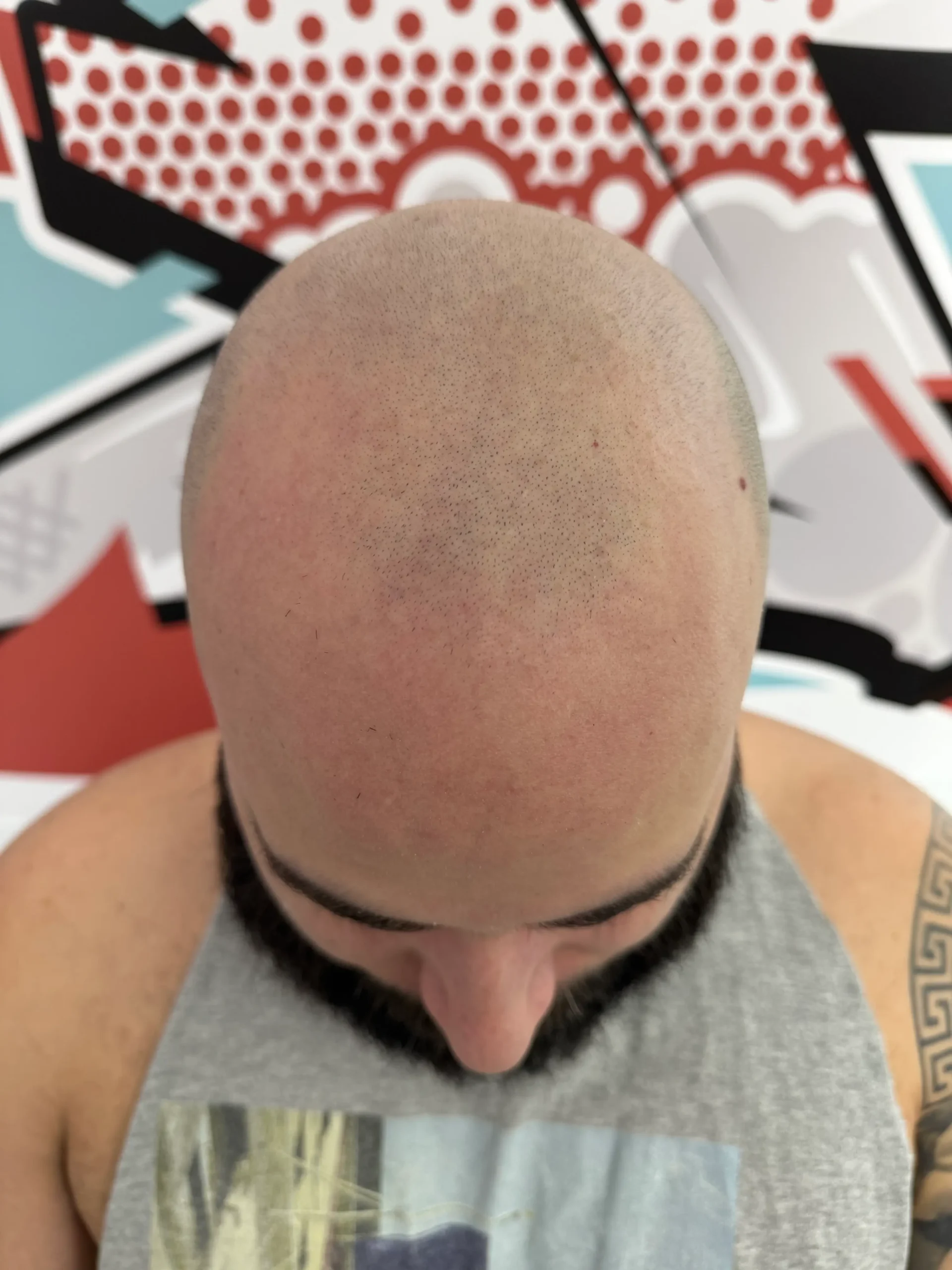 Full SMP before scalp micropigmentation